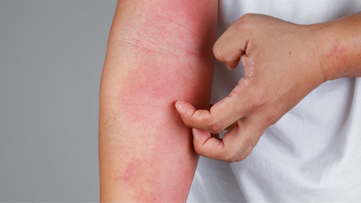 What Is Eczema and How to Treat It?