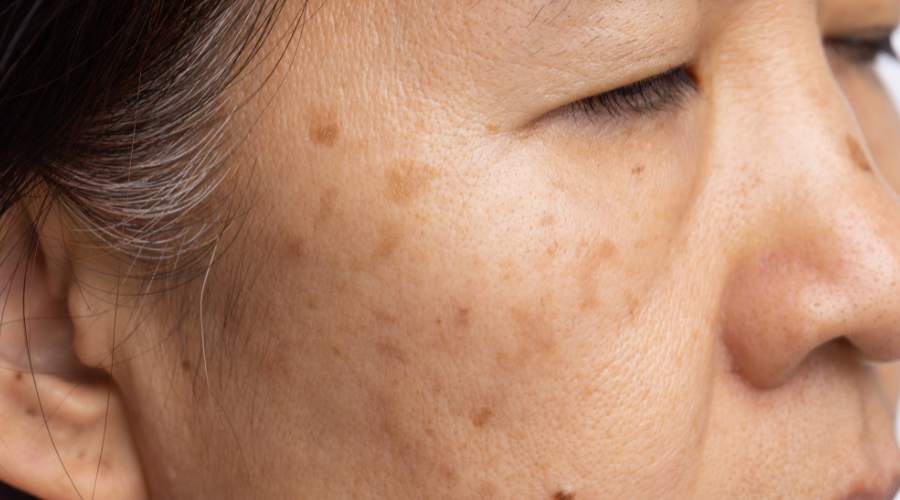 Dark Scars: How to Treat Post-Inflammatory Hyperpigmentation 