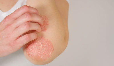 Psoriasis: how to treat this inflammatory skin disease