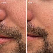 Images avant et après l'application du Masque visage tri-exfoliant pendant 5 minutes sur le visage d'un homme. Diminution visible de l'apparence des pores et imperfections.