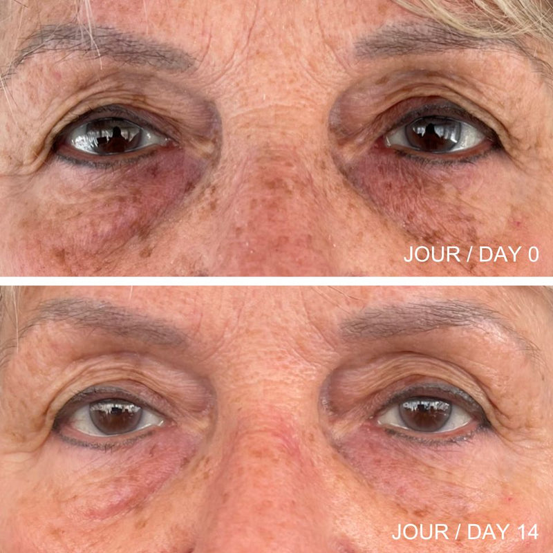 Images des résultats avant et après sur les cernes et les rides d'une femme âgée suite à l'utilisation de la crème contour des yeux multi-action.