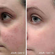 Photos de la peau d'une femme cliente avec de la rougeur et des vaisseaux sanguins dilatés et une photo de la  même peau sans rougeur suite è l'utilisation du lait nettoyant nutri-B5.