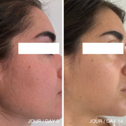 Image du profile d'une femme et de sa peau présentant des rougeurs et un manque d'éclat, et une photo du résultat après l'utilisation de l'Huile Pure d'Omy Laboratoires.