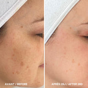 Image du profile d'une femme et de sa peau présentant des taches pigmentaires, et une photo du résultat après l'utilisation de l'Huile Pure d'Omy Laboratoires.